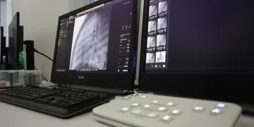 El IMSS Quintana Roo realiza las primeras intervenciones de cateterismo pediátrico