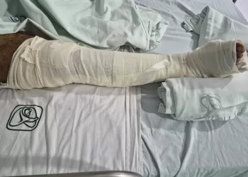 Chetumal.- Derechohabientes del Instituto Mexicano del Seguro Social (IMSS) en Chetumal denunciaron las pésimas condiciones en las cuales se encuentra la clínica, ya que pacientes de traumatología llevan más de tres semanas sin ser atendidos y pasando un calvario desde su ingreso a urgencias, hasta ahora que se encuentran en piso, sin que los encargados de la coordinación den informes o una solución, pues al parecer el médico traumatólogo que los atiende ha renunciado. Son al menos siete pacientes con fracturas en manos, brazos, fémur y tobillo, que llevan internados entre tres semanas, a mes y medio, sin que hasta el momento sean intervenidos quirúrgicamente por parte del traumatólogo Miguel Obeso Ancheita, pese a ser programados de manera semanal, pues este doctor solo está asignado a los fines de semana. Estos han pasado un calvario desde su ingreso a urgencias, hasta ahora que se encuentran en piso, sin que los encargados de la coordinación den una solución, informes o respuesta, pues al parecer el médico traumatólogo que los atiende ha renunciado pues no saben nada de él desde hace dos semanas, ya que no ha llegado a “visitar” a sus pacientes. “Ya llevo 26 días esperando una cirugía de muñeca. Primero estuve dos semanas en urgencias en unas condiciones pésimas; primero en una silla de ruedas, luego en una banca, luego en un reposet porque no tienen camillas y después de 15 días nos pasan a piso y nos traen a puras vueltas de que nos van a operar y nada. El sábado 7 me programaron pero nada, ya lleva dos semanas que no se presenta el doctor Obeso”, abundó uno de los pacientes. Además de la nula operación y sin respuesta a que sucederá, otra preocupación de las personas internadas es la generación de alguna infección ya que tienen heridas expuestas sin que haya médico tratante, e incluso algunos ya tienen enfermedades respiratorias sin medicamentos, ya que el personal de enfermería no les puede suministrar medicamentos sin autorización. “Mi hijo tiene fractura de fémur y tobillo, entonces la fémula ya tiene tiempo y no se la quieren cambiar porque tiene heridas expuestas que solo se las limpian, pero no pasa a más ya que él necesita operación”, comentó la madre de un paciente, que prefirieron no mencionar nombres por temor a que los dejen esperando más tiempo sin atención. Muchos de ellos no están canalizados, pues solo les aplican los medicamentos horas antes de que sean trasladados al quirófano, pero su sorpresa es que al llegar y luego de varias horas les dicen “que siempre no serán intervenidos porque no hay médico”. Los pacientes pidieron comprensión de los responsables de Coordinación del IMSS y se les asigne un médico especialista para poder brindarles la atención que requieren, pues muchos de ellos son padres de familia y con un trabajo que a pesar de tener incapacidad temen perderlo. Esto porque el personal de coordinación ya no se quiere hacer responsable ni dar atención a los familiares de los pacientes. “Fui hablar con el coordinador de nombre Lorenzo y se portó muy déspota, me dijo que si tengo que acudir a los medios lo haga, porque al final del día el trabaja por gusto y no por necesidad y si lo corren o no, no le afecta en nada. Pero aquí nos preocupa porque él no es quien está internado sin la atención”, aseguró otro de los afectos. Los pacientes reiteraron que desconocen que sucederá con sus casos, puesto que temen una lesión mayor con las fracturas que solo se encuentran vendadas o en otros casos expuestas por tener heridas abiertas. Por lo tanto hicieron un llamado al delegado del IMSS en Quintana Roo e incluso a la propia gobernadora del Estado, Mara Lezama para que sean asignados a otro médico traumatólogo, pues han escuchado casos que pueden tener un médico temporal para la atención de pacientes.