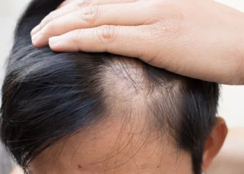 Estrés y problemas hormonales elevan casos de caída de cabello; Cancún apuesta por el turismo médico capilar