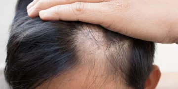 Estrés y problemas hormonales elevan casos de caída de cabello; Cancún apuesta por el turismo médico capilar